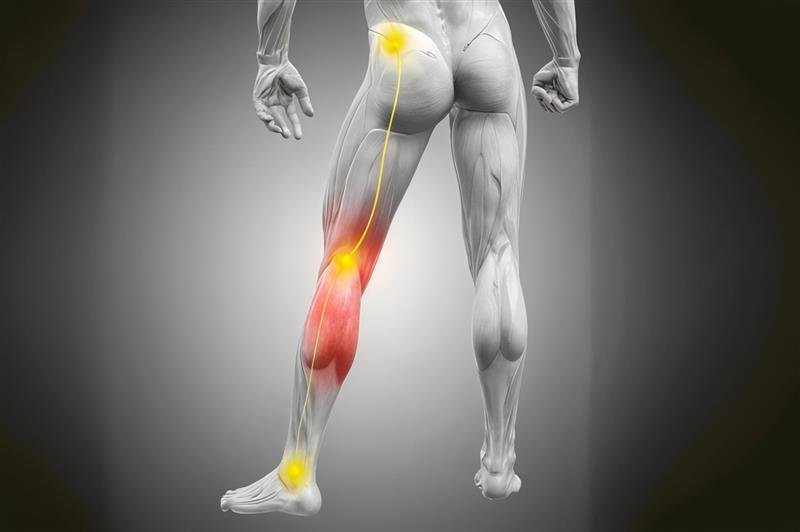 sciatica pain treatment