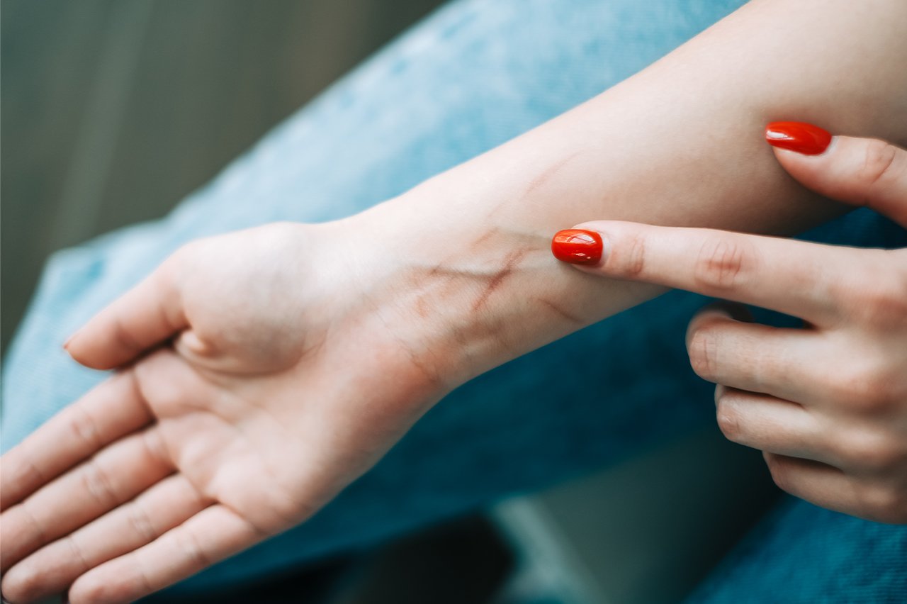 Vascular Pain