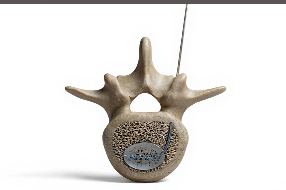 Vertebroplasty treatment