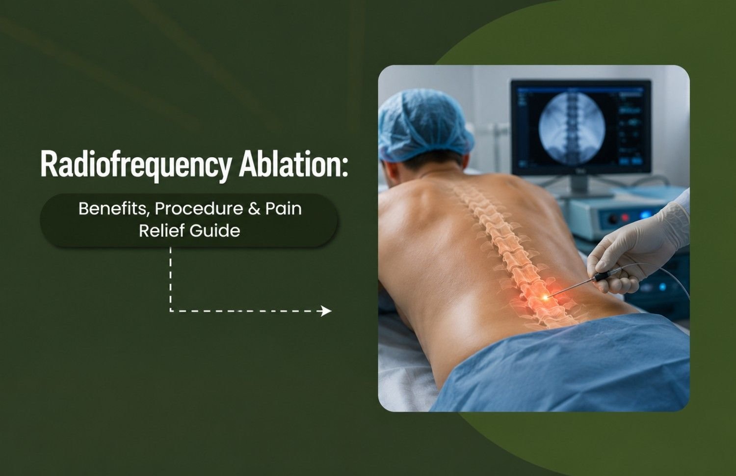 Radiofrequency Ablation: Benefits, Procedure & Pain Relief Guide